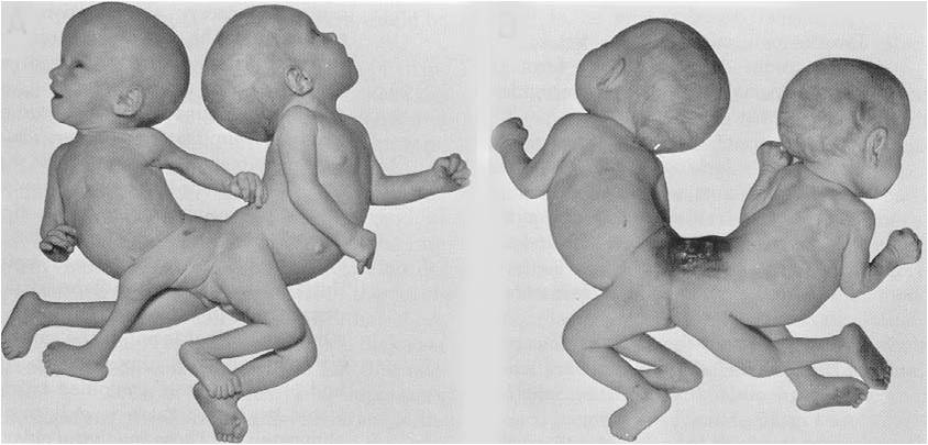 המרכז הירושלמי לעל קול וארבע מימד - Types Of Conjoined Twins